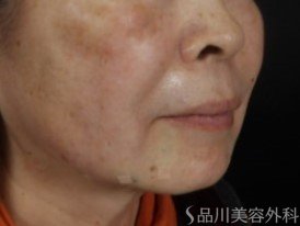 症例NO.73530のAFTER写真