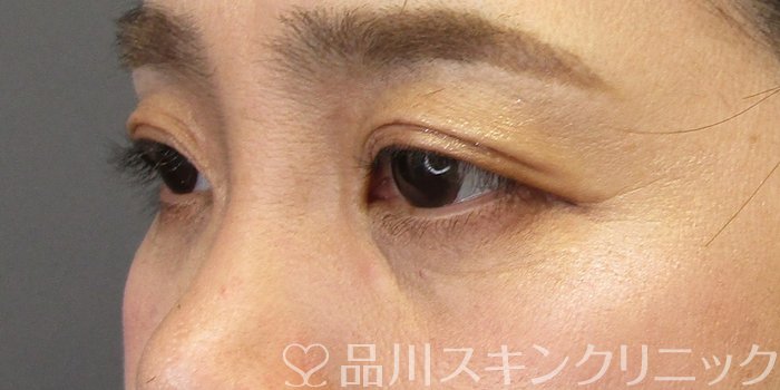 症例NO.75173のBEFORE写真