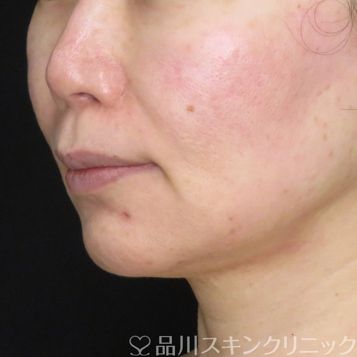 症例NO.62286のBEFORE写真
