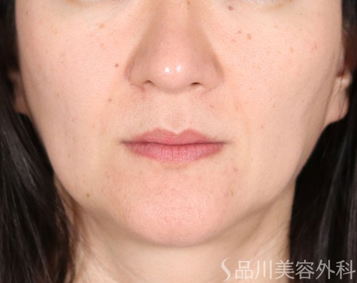 症例NO.72490のBEFORE写真