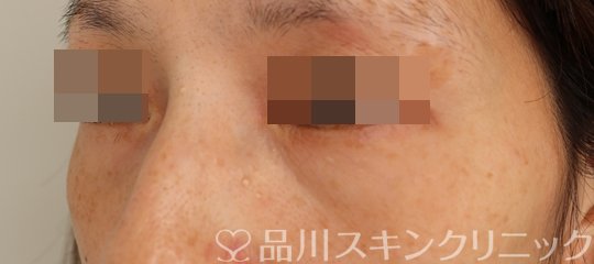 症例NO.71055のBEFORE写真