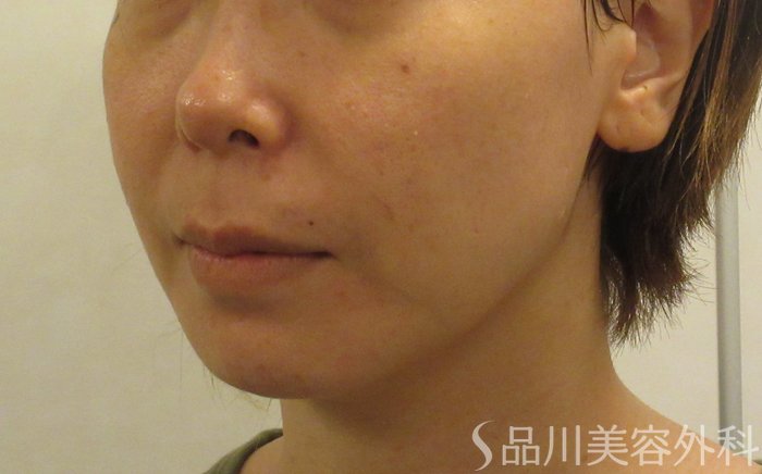 症例NO.71495のBEFORE写真