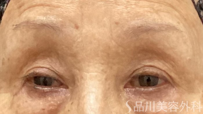 症例NO.69511のAFTER写真