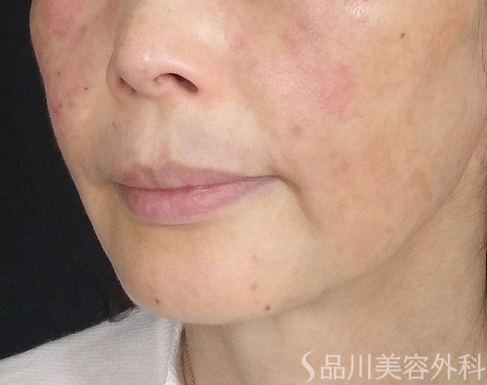 症例NO.65307のBEFORE写真