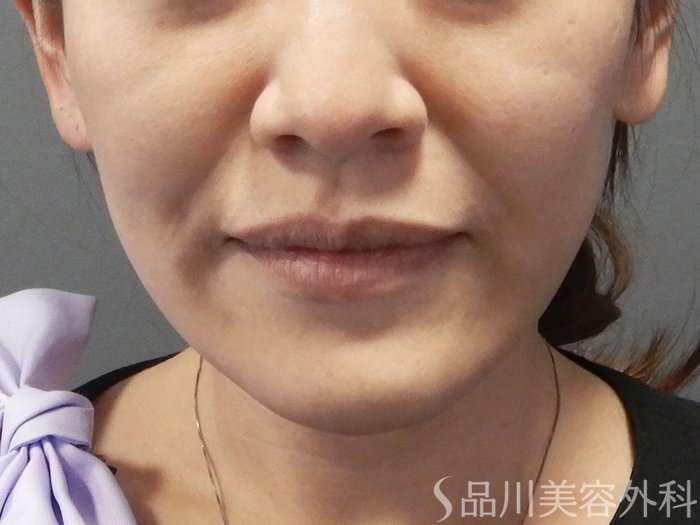 症例NO.73145のBEFORE写真