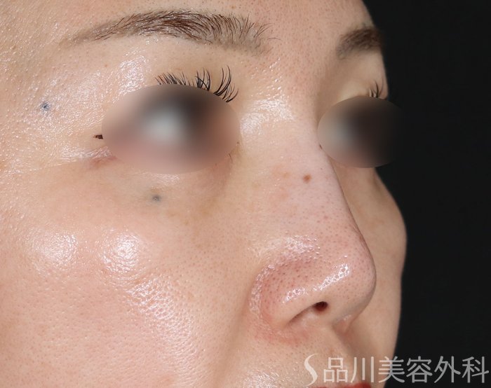 症例NO.74195のBEFORE写真