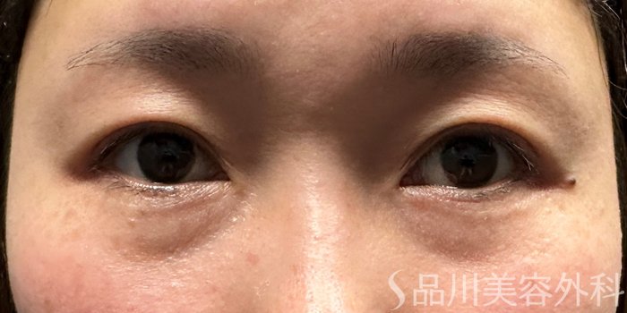 症例NO.64940のBEFORE写真