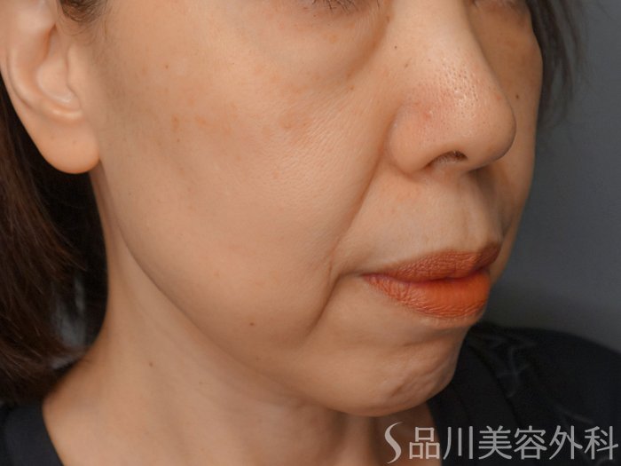 症例NO.74372のBEFORE写真