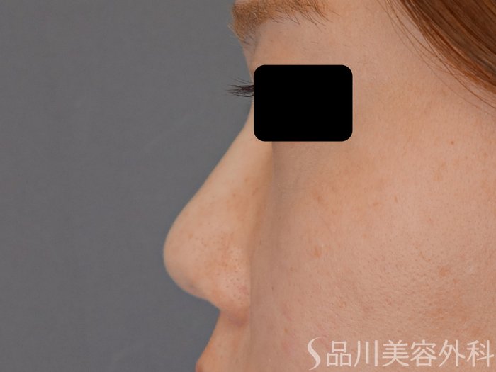 症例NO.72184のAFTER写真