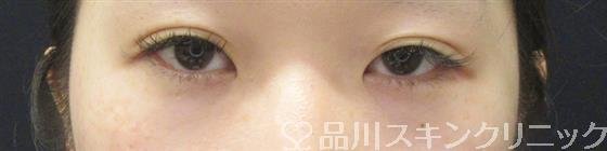 症例NO.61784のBEFORE写真