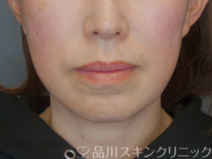 症例NO.72596のBEFORE写真