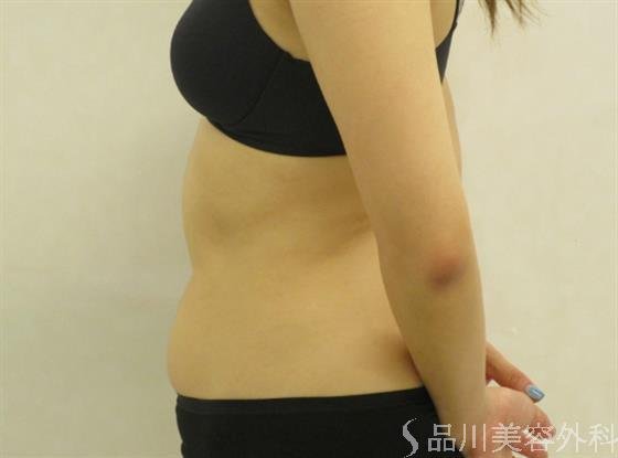 症例NO.60621のAFTER写真