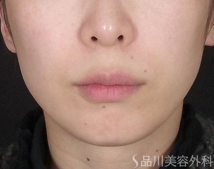 症例NO.69193のBEFORE写真