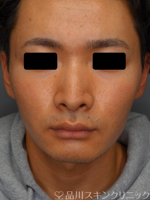 症例NO.73585のBEFORE写真