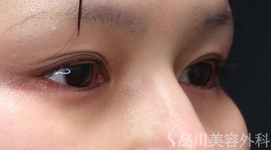 症例NO.75188のBEFORE写真