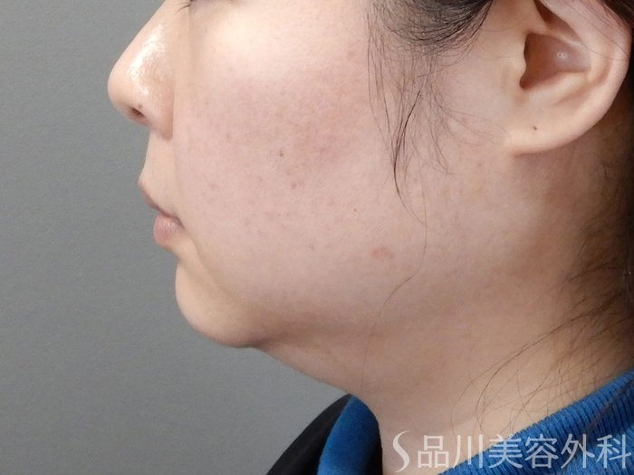 症例NO.69445のBEFORE写真