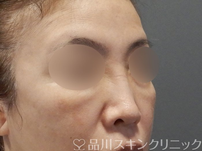 症例NO.75044のAFTER写真