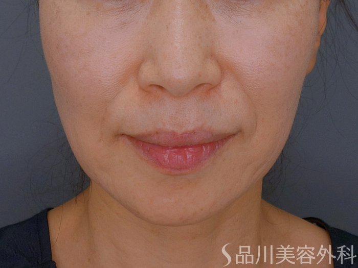 症例NO.74502のBEFORE写真
