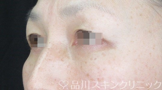 症例NO.69492のAFTER写真
