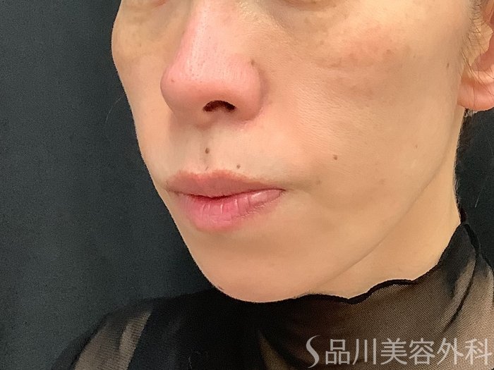 症例NO.67760のAFTER写真