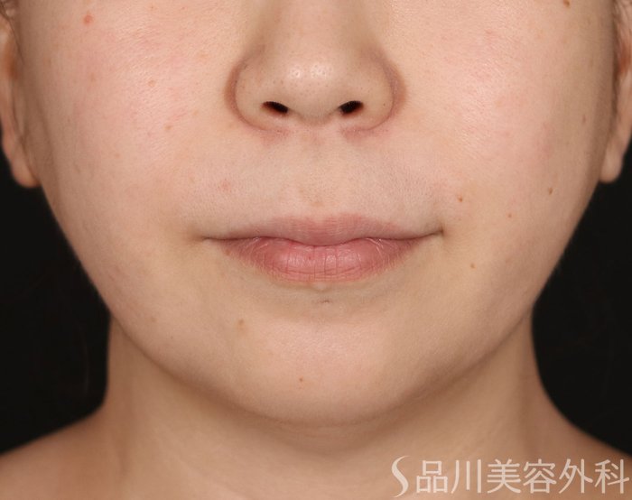 症例NO.70855のBEFORE写真