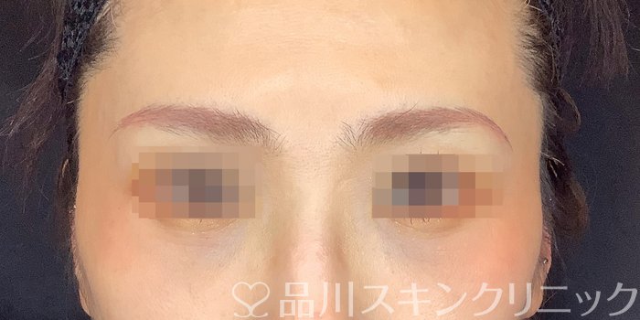 症例NO.68735のAFTER写真
