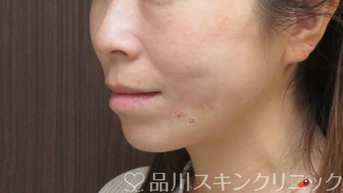 症例NO.72170のAFTER写真