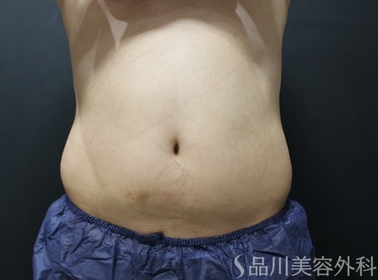 症例NO.74674のBEFORE写真