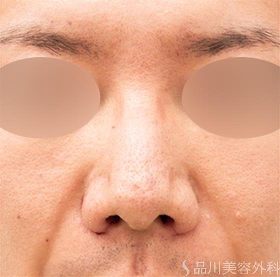 症例NO.53008のAFTER写真