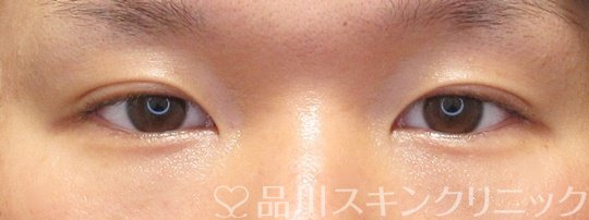 症例NO.70953のAFTER写真