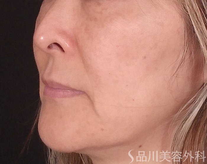 症例NO.70378のBEFORE写真