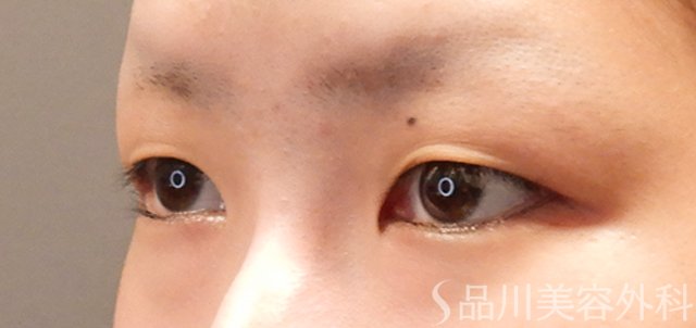 症例NO.72382のBEFORE写真