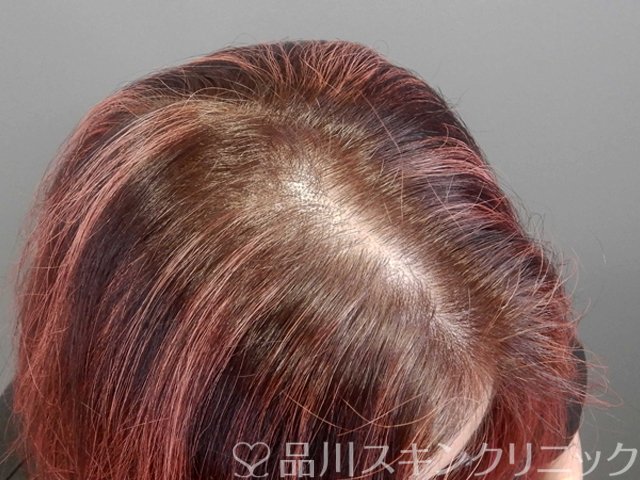 症例NO.69587のBEFORE写真