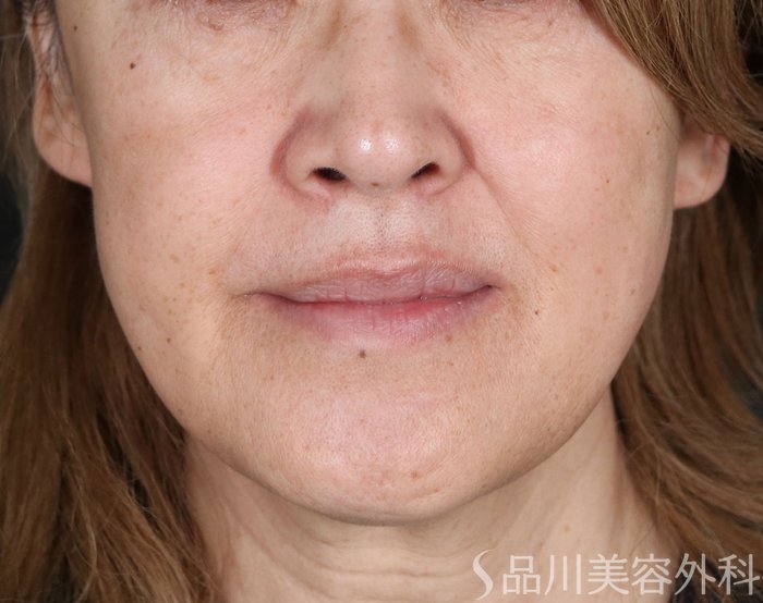 症例NO.73497のBEFORE写真