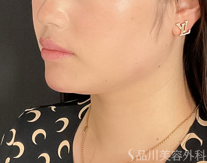 症例NO.74823のAFTER写真
