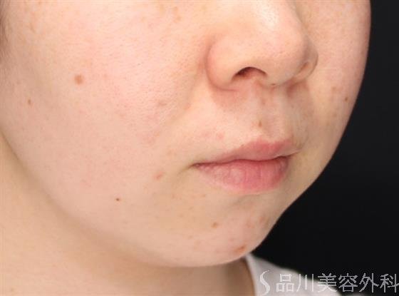 症例NO.60876のBEFORE写真