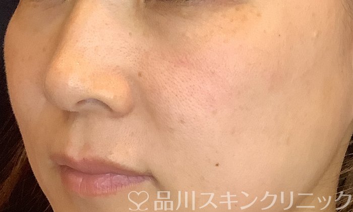 症例NO.73718のBEFORE写真