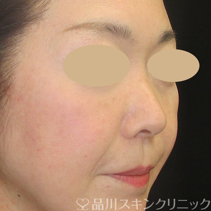 症例NO.73542のBEFORE写真