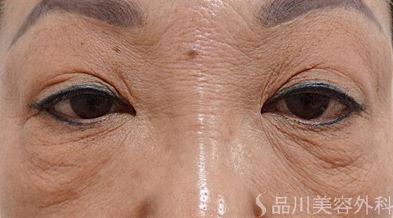 症例NO.60684のBEFORE写真