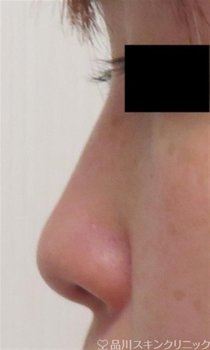 症例NO.58049のBEFORE写真