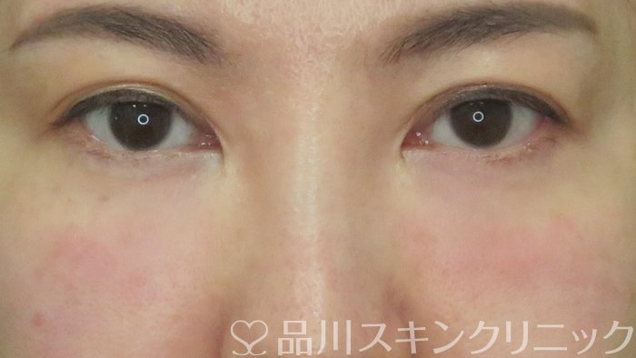 症例NO.71851のAFTER写真