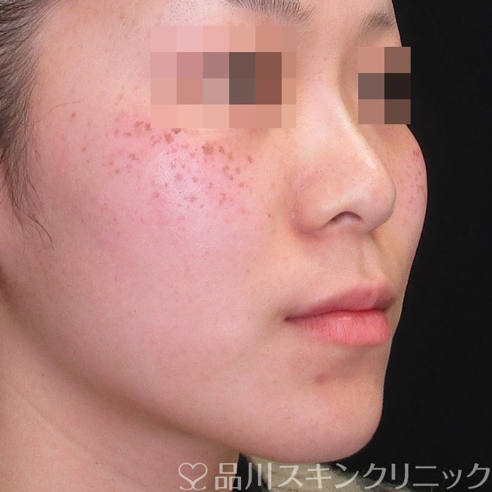 症例NO.73566のAFTER写真