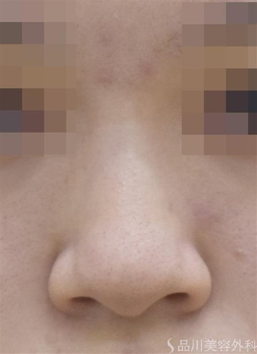 症例NO.52914のBEFORE写真