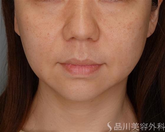 症例NO.51224のBEFORE写真