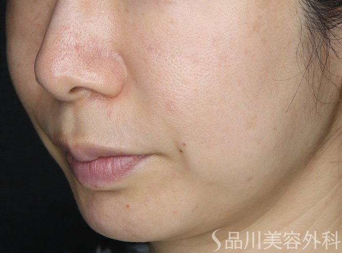 症例NO.73383のAFTER写真