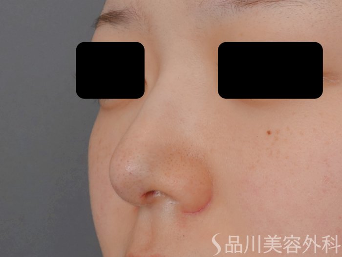 症例NO.71071のAFTER写真