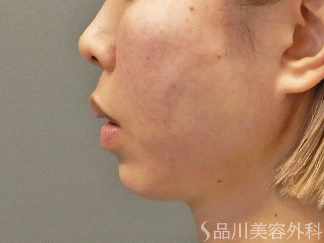 症例NO.73904のAFTER写真