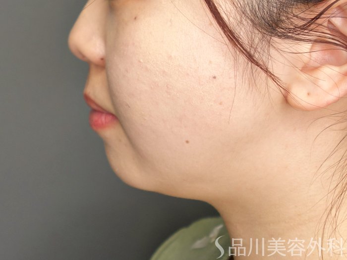 症例NO.73432のBEFORE写真