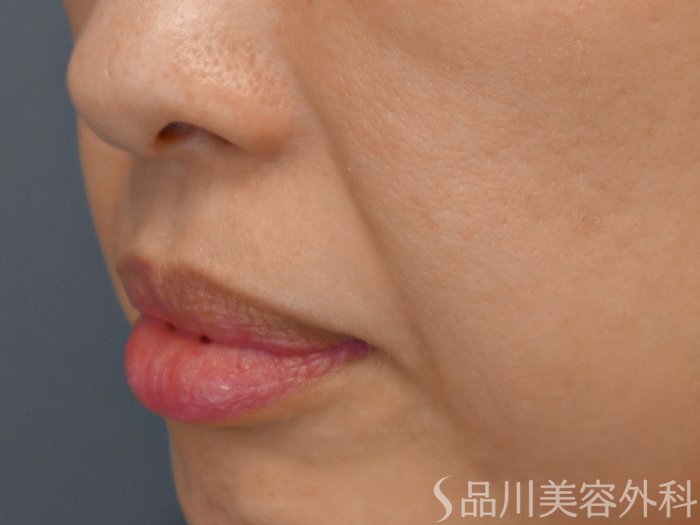 症例NO.67492のBEFORE写真