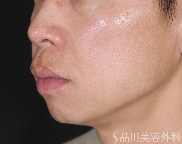 症例NO.73476のBEFORE写真